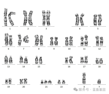 【科普】唐氏综合征知多少
